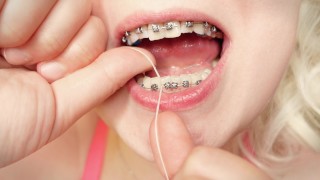 My 2Nd Day In Braces Cleaning By Dental Floss
