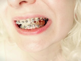 BRACES ASMR video: jelly candy_FOOD FETISH with sounds close up