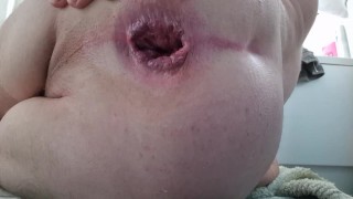 Un plug anal gonflable démarre mon cul lâche pour prolapsus 