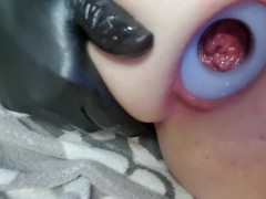 Anal gape with open access port 