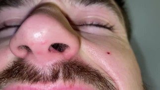 Макрофилия - выплескивание живота, шумы в желудке