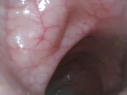 The Colonoscopy. the Rough Intestine Research of the Bowel ...