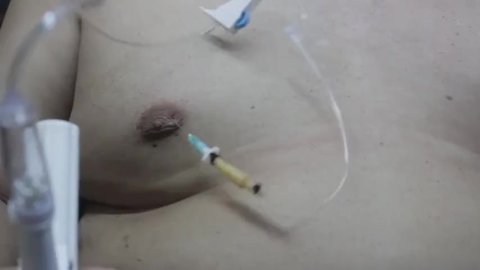 Expander port no needed, my boob inflation