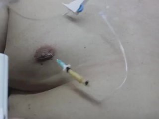 Expander Port no Needed, my Boob Inflation