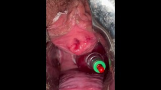 Uterine mouth suction