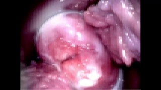 库斯科视图中的子宫颈和阴道壁