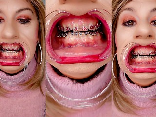 Braces Fetish! see Alexandra Braces with an Open Mouth Expander