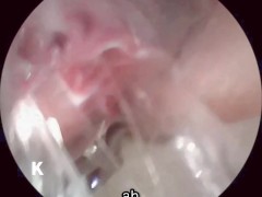 【超小型カメラ】クスコで膣の中を探検してみました。 - Screenshot 10 of 16 - Mature Woman