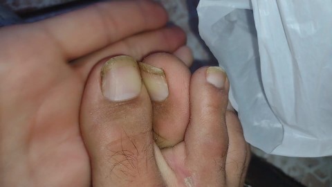 piggy toe nails Disguisting Feet