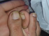 piggy toe nails Disguisting Feet