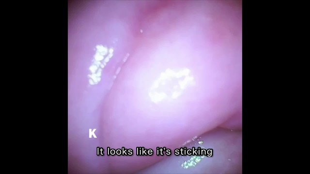 [Vaginal wall video] I took a picture of the vaginal wall with a ...