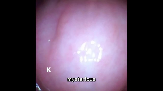 [Vaginal wall video] I took a picture of the vaginal wall with a ...
