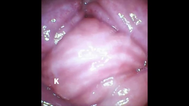 [Vaginal wall video] I took a picture of the vaginal wall with a ...