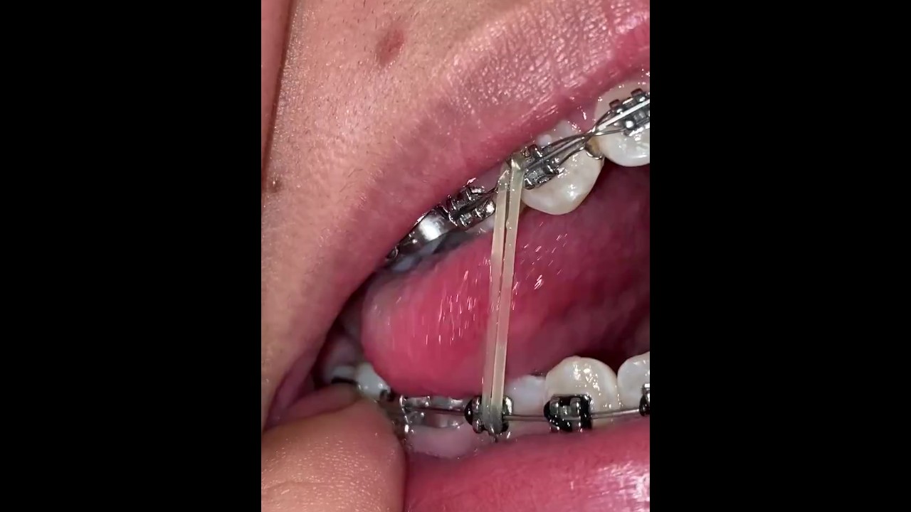 Look how many metal pieces I have in my mouth 👅