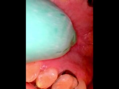 Inside my mouth (with braces)