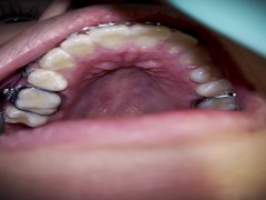 Touch my braces - Screenshot 10 of 16 - Dentista