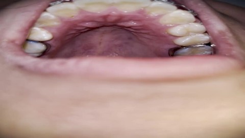 Exploring my mouth with braces (in the dentist)