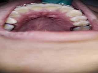 Осмотр полости рта с помощью брекетов (у стоматолога)