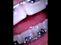 My uvula - Screenshot 8 of 16 - Girl With Braces