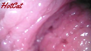 Endoskopische vaginale ♥Beobachtung