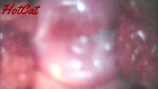 Examination Of The Cervix And Vagina After An Orgasm Inside The Pussy Spread With Cusco