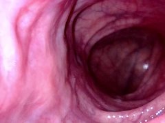 POV - Take a peek around the corner of my transverse colon
