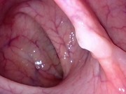 Preview 2 of Take in the view peering up my descending colon