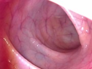 Preview 6 of Take in the view peering up my descending colon