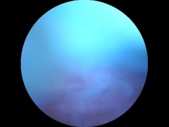 DP Endoscope for Andrew