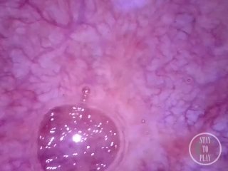 POV Endoscope Catheter Bladder Inflation - Preview