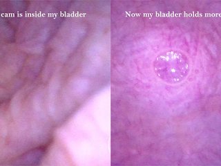 Endoskop: Meine Blase Wird Mit Einem Katheter Gefüllt - Vorschau