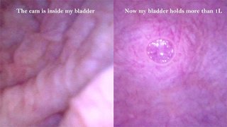 POV Endoscope Catheter Bladder Inflation - Preview