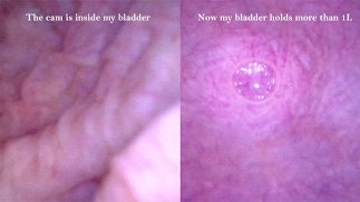 POV Endoscope Catheter Bladder Inflation - Preview