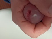 peehole enlargement while peeing