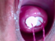 Preview 2 of 2 tampones in cervix extrem