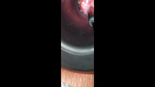 Inspeção anal com câmera de endoscópio