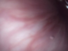 Endoscope through urethra to prostate while masterbating