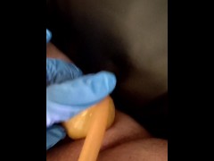 Enema with inflatable bardex nozzle for straight guy ass