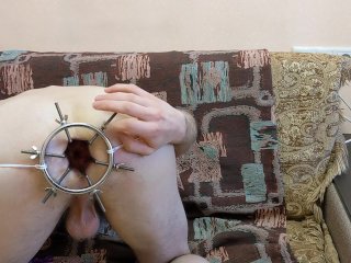 Anal dilation with 6 rode anal dilator