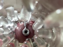 Super camera. Cumming in pussy from a catheter - Screenshot 3 of 16 - Pussy Full Off Cum