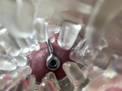 Super camera. Cumming in pussy from a catheter - Screenshot 8 of 16 - Pussy Full Off Cum