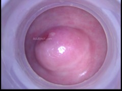 Cervix behind the scenes heartbeat pulse raw footage Nabothian cyst