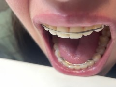 Retainer Mouth Closeup (PREVIEW)